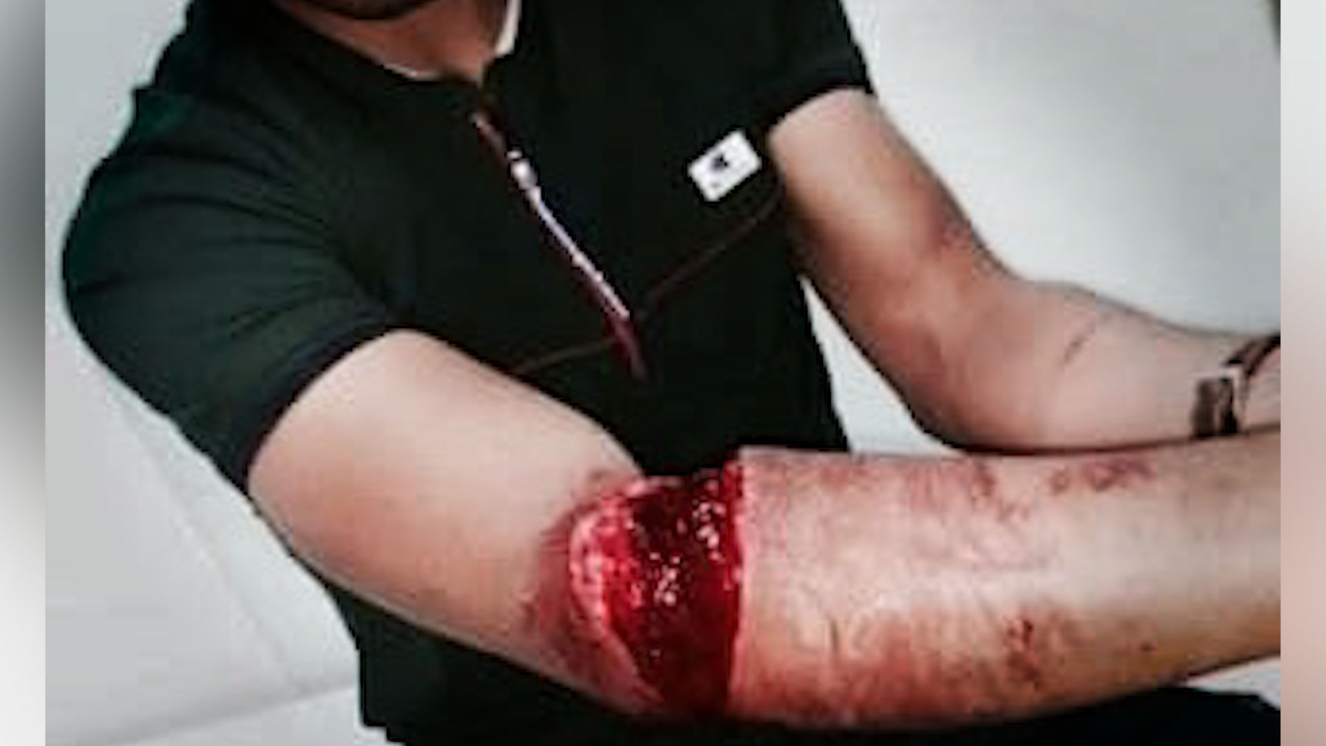 ضحية "الأولتراس" يخضع لجراحة دقيقة.. و"بتر اليد" رهين بالتجاوب العصبي