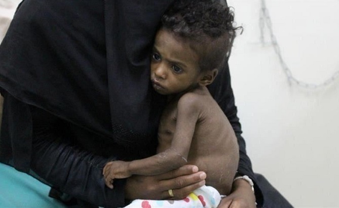  الأمم المتحدة تحذر من عودة تفشي الكوليرا في اليمن 