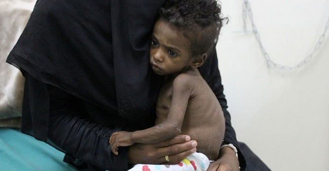 اليمن.. 63 حالة وفاة بوباء الكوليرا في تعز