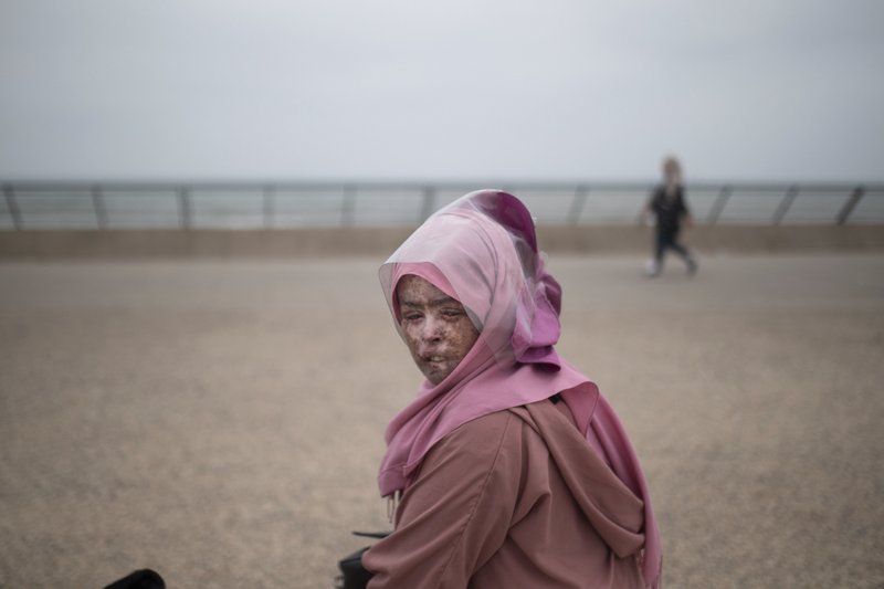 عندما يُصبح الضوء مُهلكاً.. مغاربة يكافحون "تلفا جلديا" نادرا