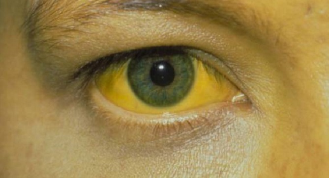 نيجيريا: 15 حالة إصابة مؤكدة بالحمى الصفراء