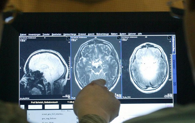  جهاز جديد يقلل فقدان الذاكرة لدى مرضى الزهايمر 