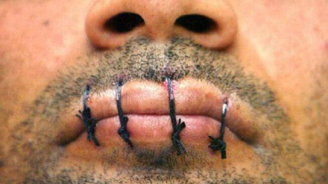  إيطاليا.. مغربي يخيط فمه احتجاجا على قسوة المعاملة بمركز لإيواء المهاجرين 