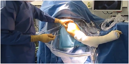 الفقيه بن صالح.. نجاح عملية جراحية فريدة لاستبدال كتف بشري بمفصل اصطناعي