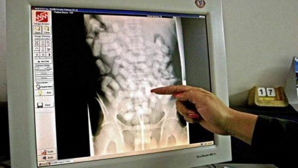  اعتقال 18 شخصا حاولوا تهريب المخدرات داخل أمعائهم عبر الميناء المتوسطي 