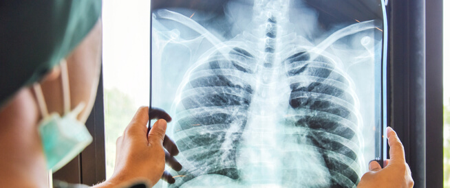  منظمة الصحة العالمية: ارتفاع عدد الوفيات بداء السل عبر العالم لأول مرة منذ عقد 