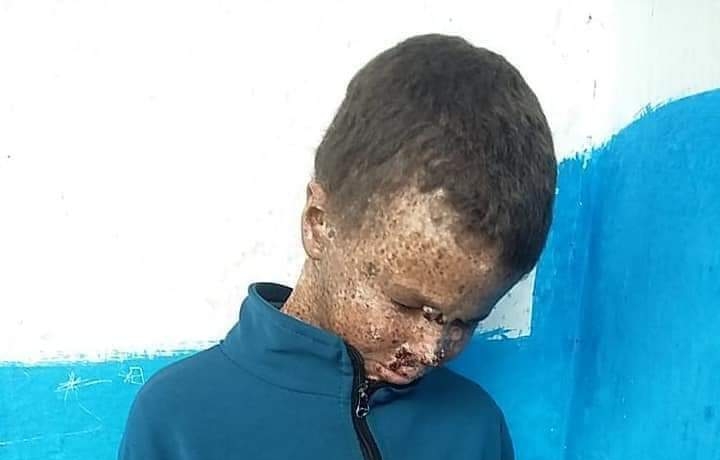 مأساة أحد "أطفال القمر" بنواحي شفشاون.. الأطباء تجاهلوا مرضه وأسرته لم تفهم حالته وتعرضه للشمس حول حياته إلى جحيم