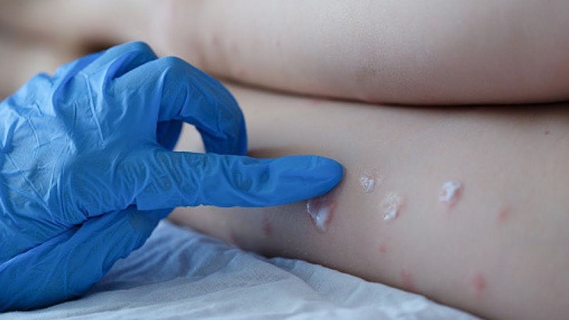  منظمة الصحة العالمية: تفشي إصابات جدري القردة في أكثر من 50 دولة لا يزال يمثل خطرا كبيرا 