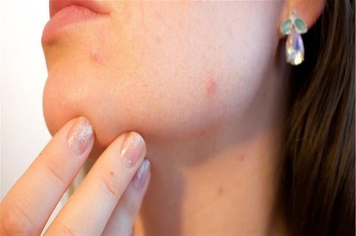 خبير: جدري القردة كان ينتشر في العالم منذ سنوات دون اكتشافه!