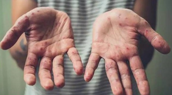 إصابات جدري القردة ترتفع إلى أكثر من 3400 حالة