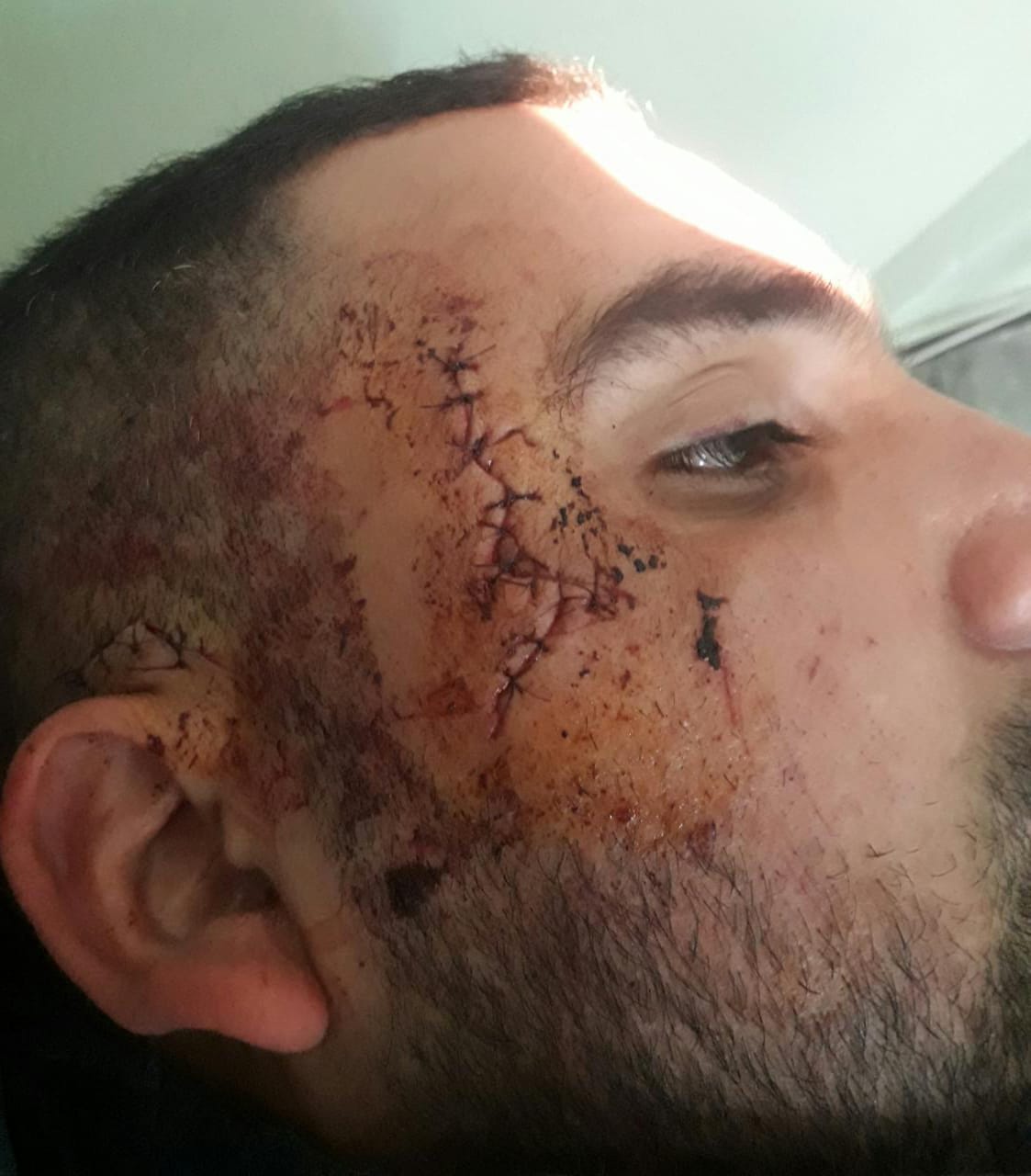 اعتداء على فاعل جمعوي بنواحي طنجة يتسبب له بـ 23 غرزة في الوجه بسبب مباراة في كرة القدم