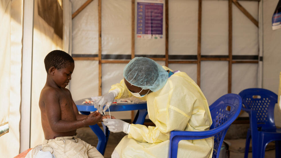  منظمة الصحة العالمية تؤكد إمكانية "السيطرة" على جدري القردة 