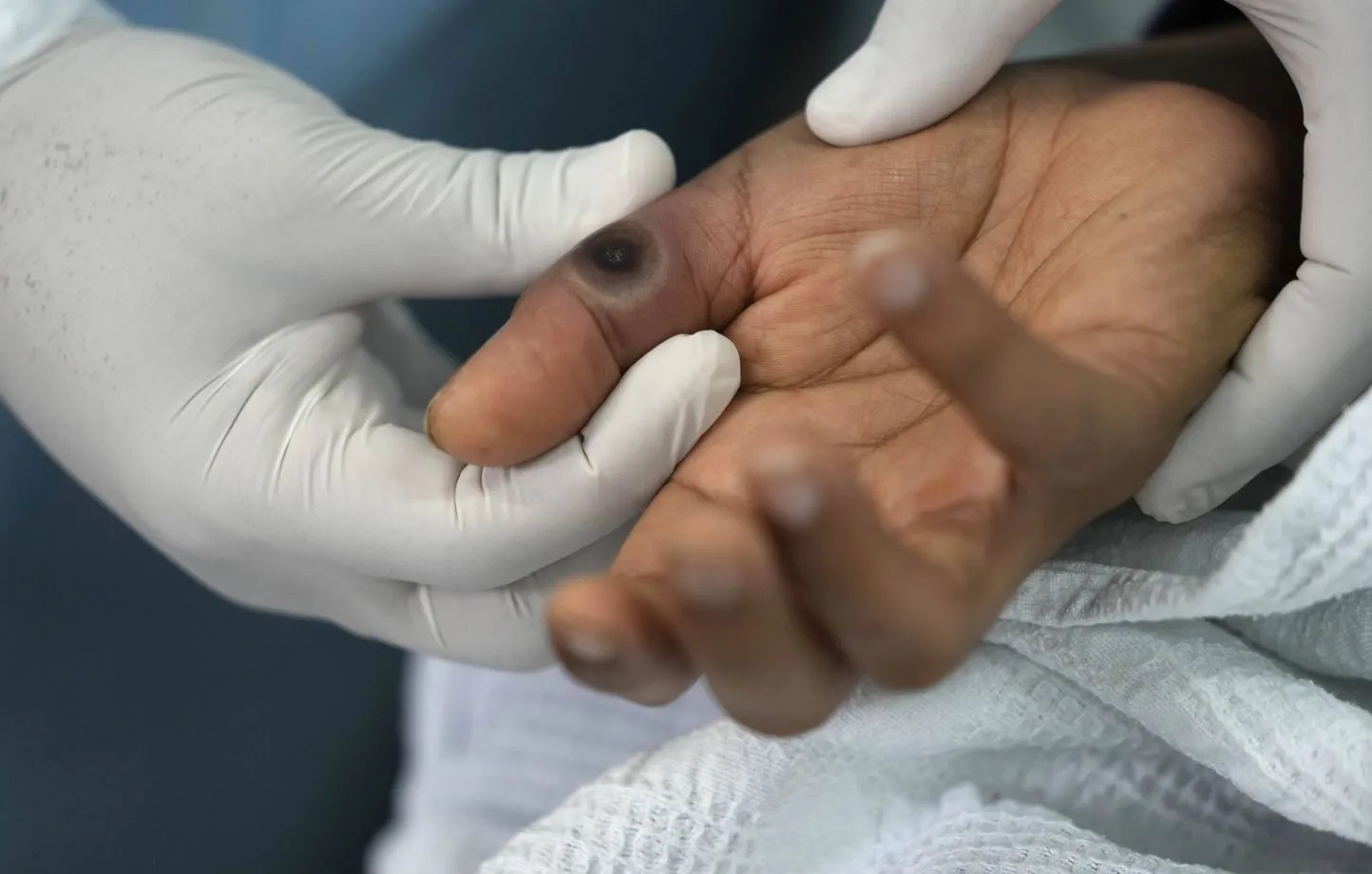 وزارة الصحة تُعلن عن تسجيل أول حالة إصابة بجدري القردة في المغرب