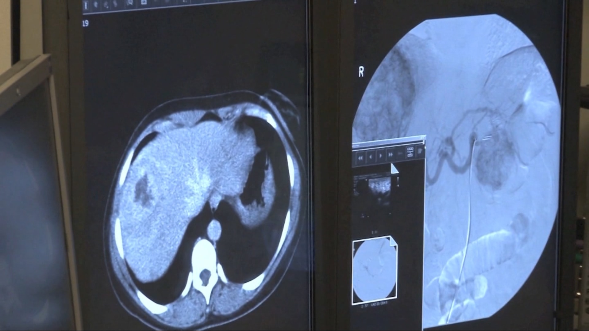  السعودية تنجح في إجراء أول عملية زراعة كبد روبوتية في العالم 